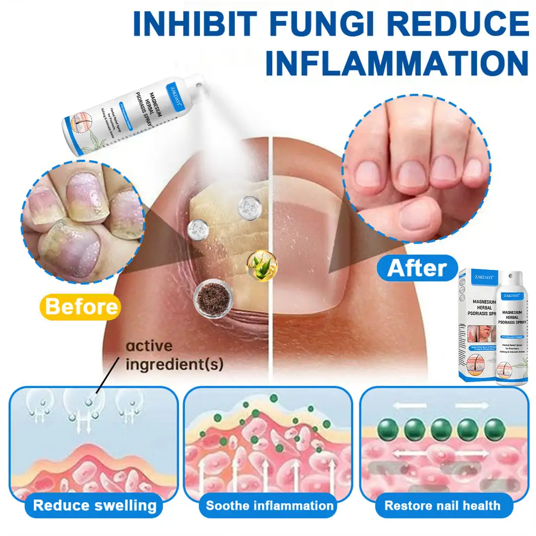 ✅Official Store: Zakdavi™ Magnesium Herbal Psoriasis Spray – FDA Certified Relief for Psoriasis, Eczema & Skin Tags