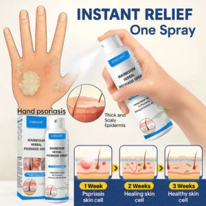 ✅Official Store: Zakdavi™ Magnesium Herbal Psoriasis Spray – FDA Certified Relief for Psoriasis, Eczema & Skin Tags