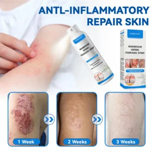 ✅Official Store: Zakdavi™ Magnesium Herbal Psoriasis Spray – FDA Certified Relief for Psoriasis, Eczema & Skin Tags