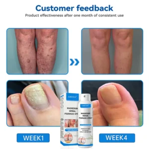 ✅Official Store: Zakdavi™ Magnesium Herbal Psoriasis Spray – FDA Certified Relief for Psoriasis, Eczema & Skin Tags