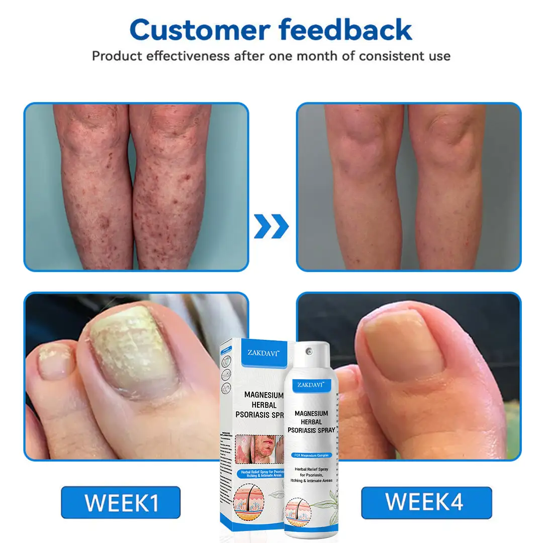 ✅Official Store: Zakdavi™ Magnesium Herbal Psoriasis Spray – FDA Certified Relief for Psoriasis, Eczema & Skin Tags