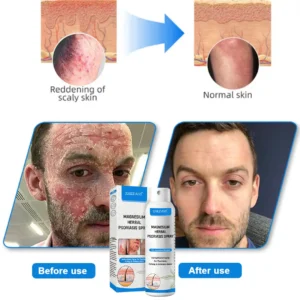 ✅Official Store: Zakdavi™ Magnesium Herbal Psoriasis Spray – FDA Certified Relief for Psoriasis, Eczema & Skin Tags