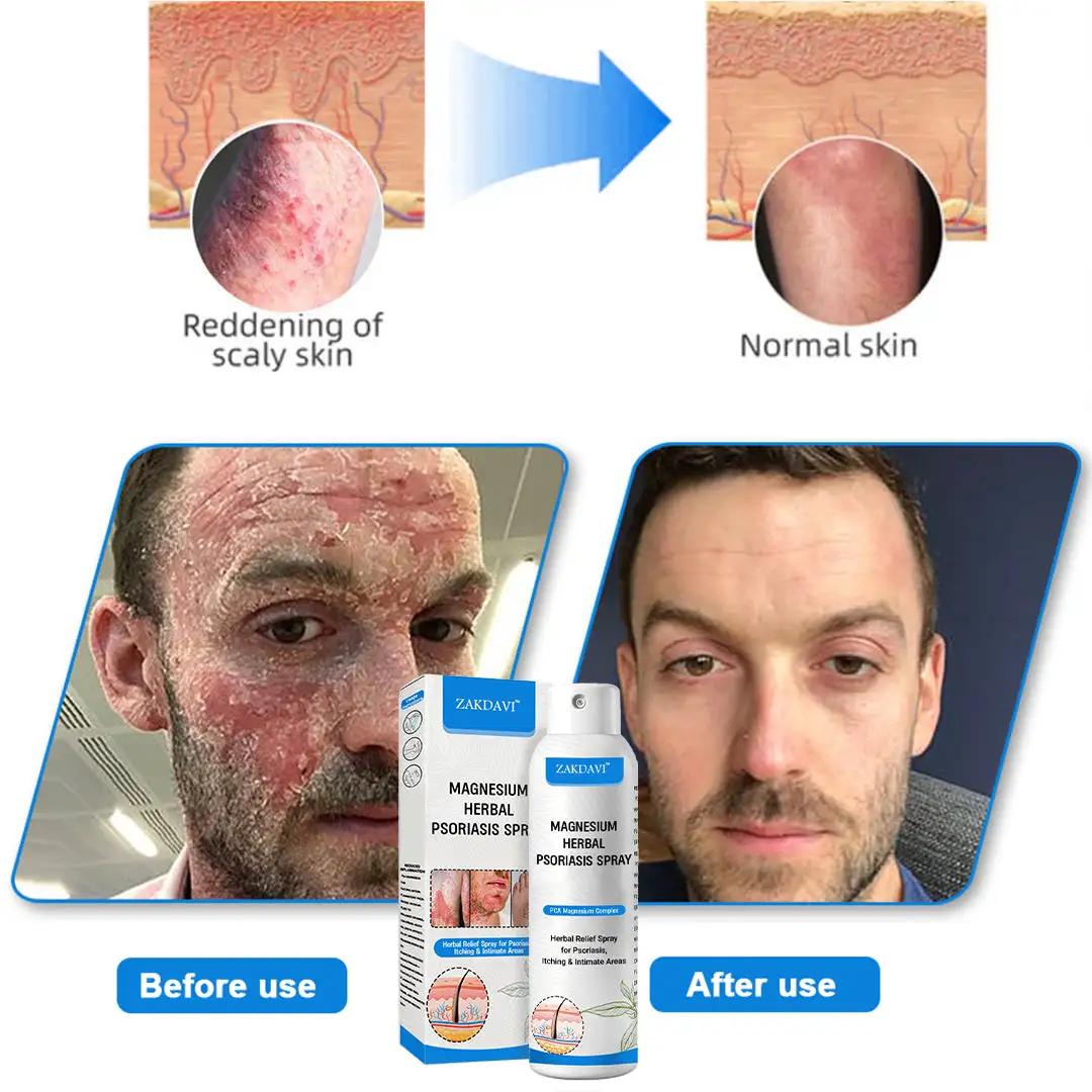 ✅Official Store: Zakdavi™ Magnesium Herbal Psoriasis Spray – FDA Certified Relief for Psoriasis, Eczema & Skin Tags