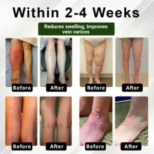 Zakdavi™ FluidEase Leg Therapy Edema Cream